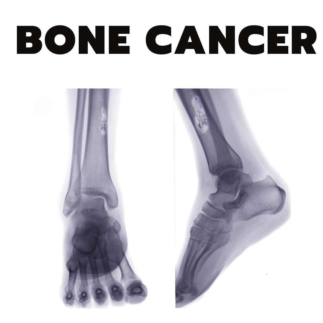 Bone Cancer