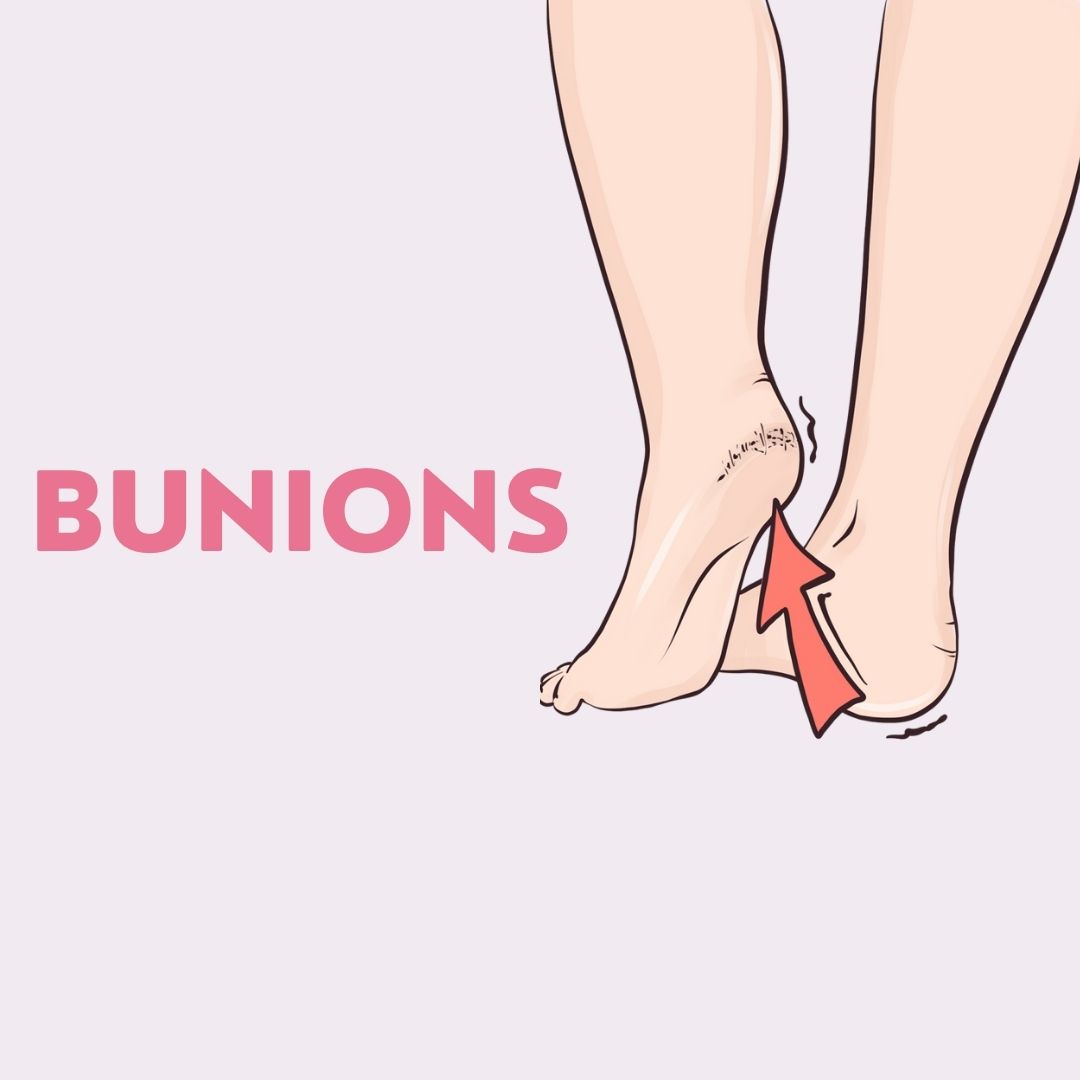Bunions