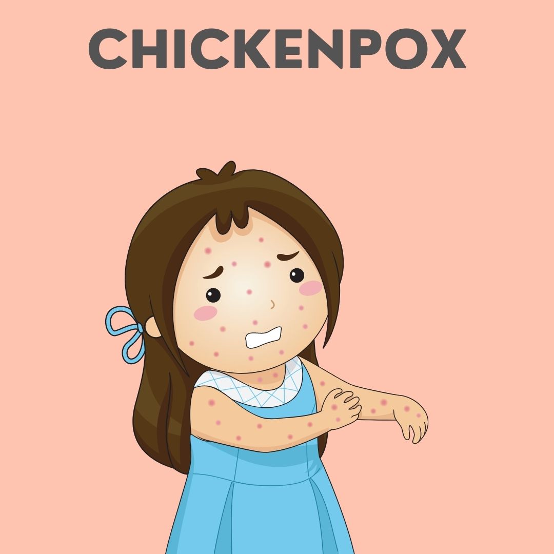 Chickenpox