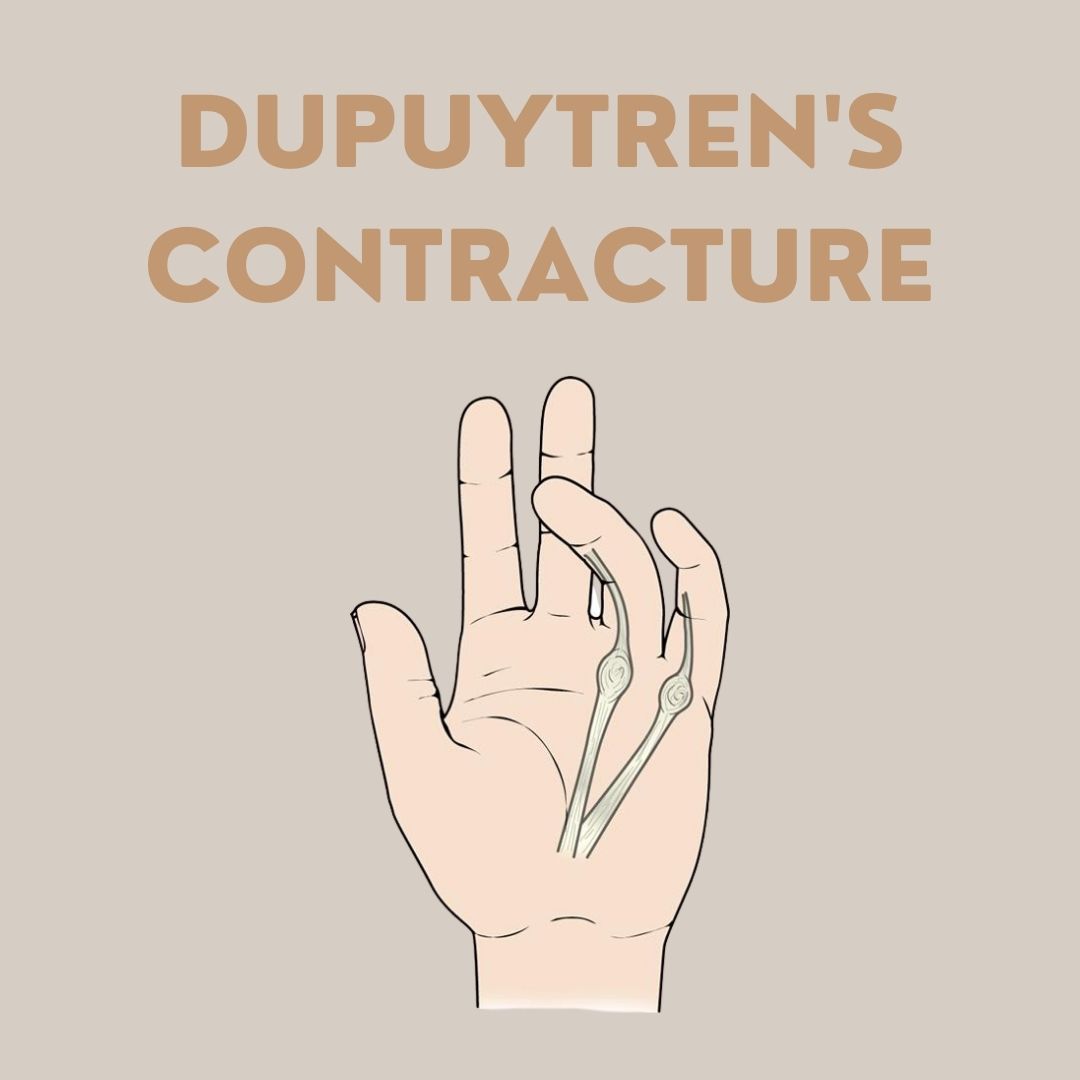 Dupuytren's Contracture