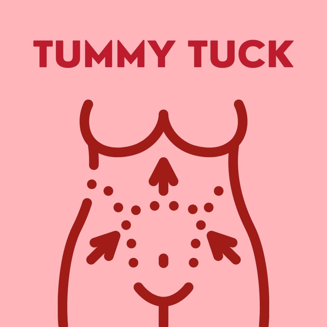Tummy Tuck