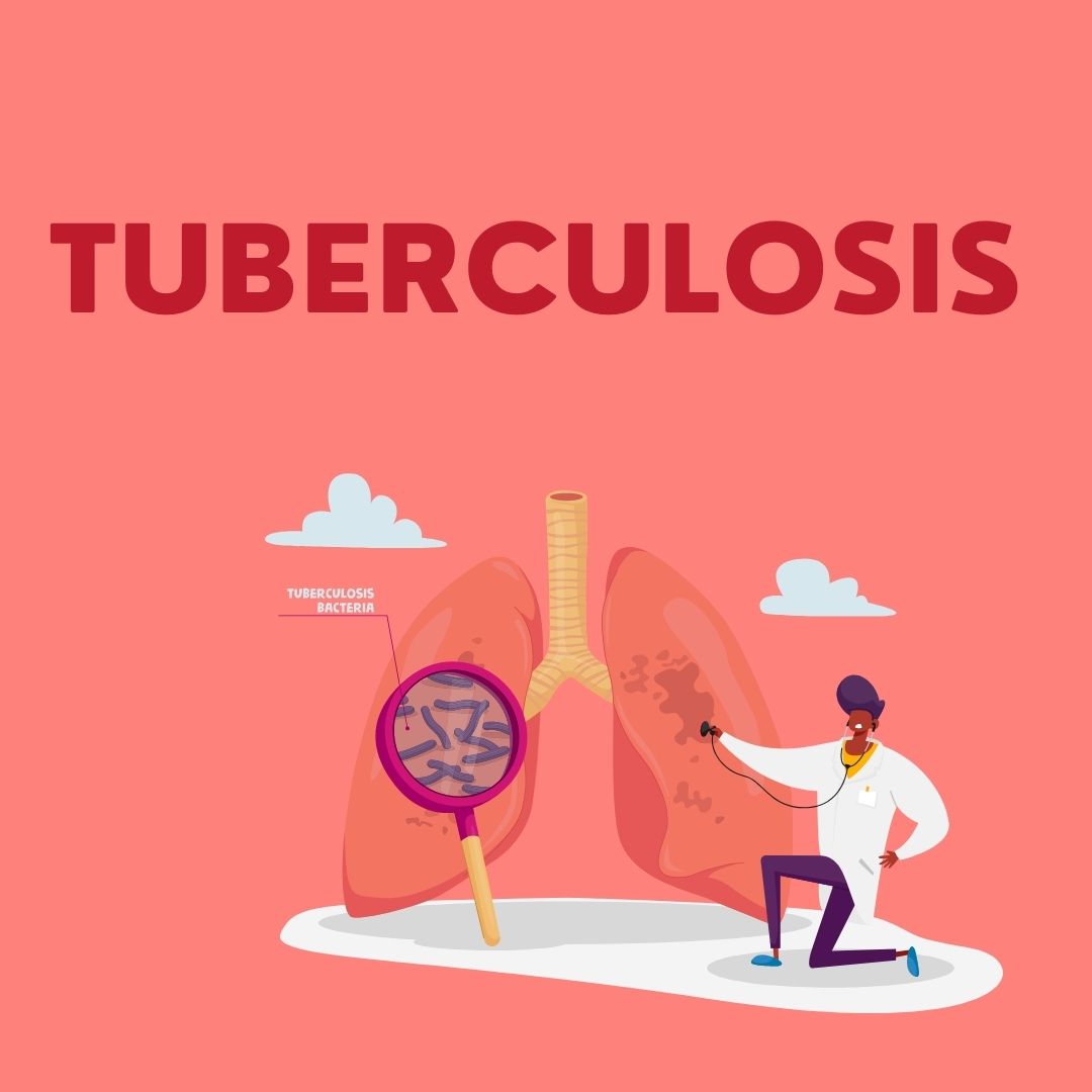 Tuberculosis