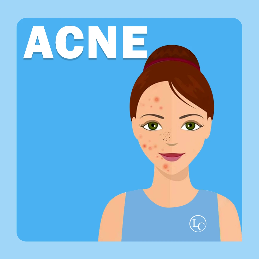 Acne