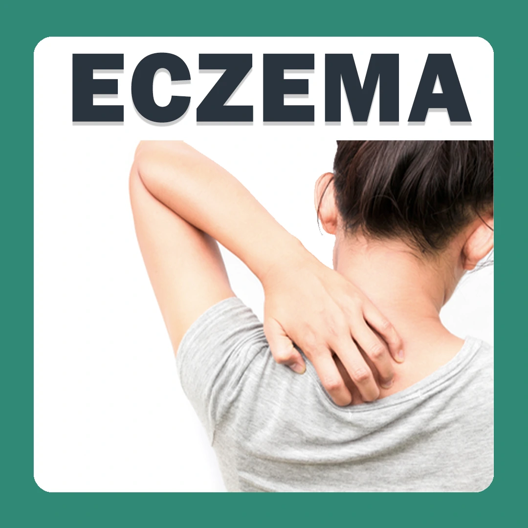 Eczema