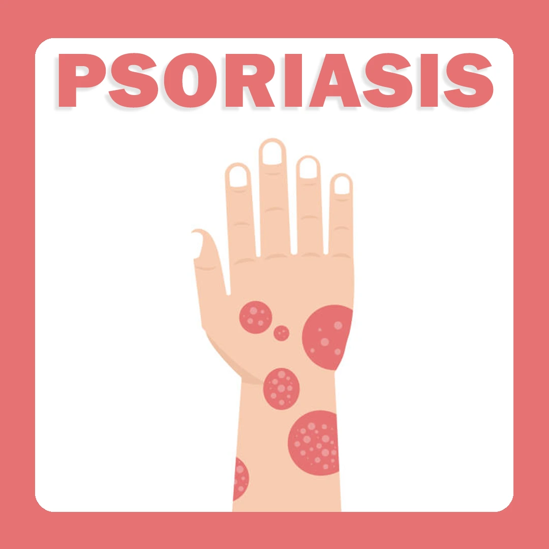 Psoriasis
