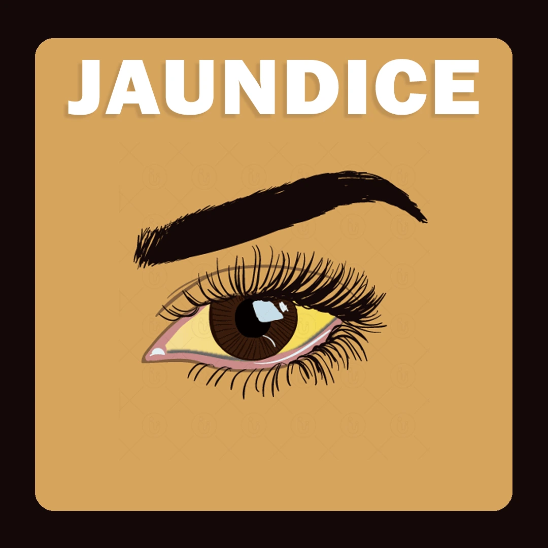 Jaundice