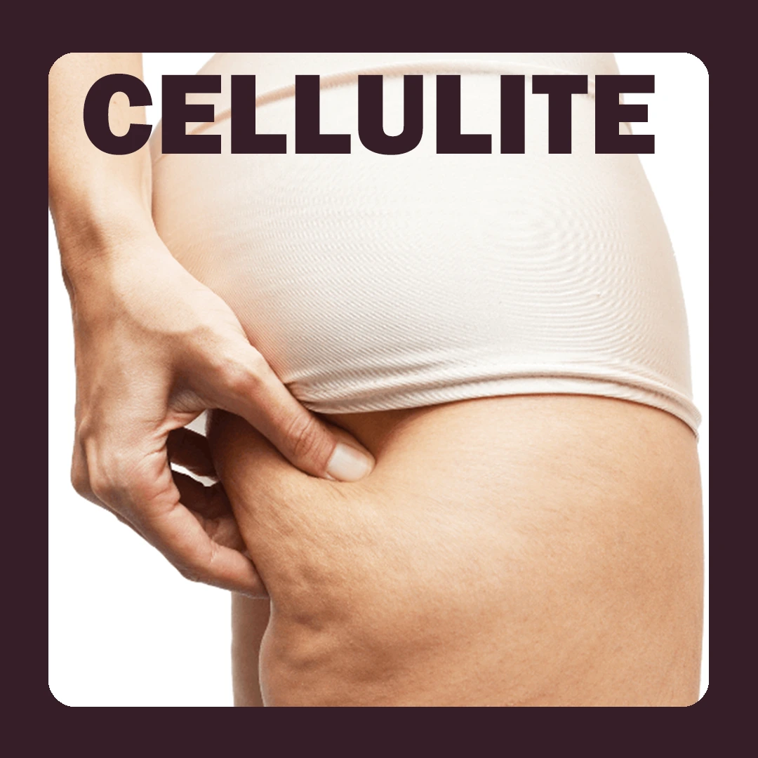 Cellulite