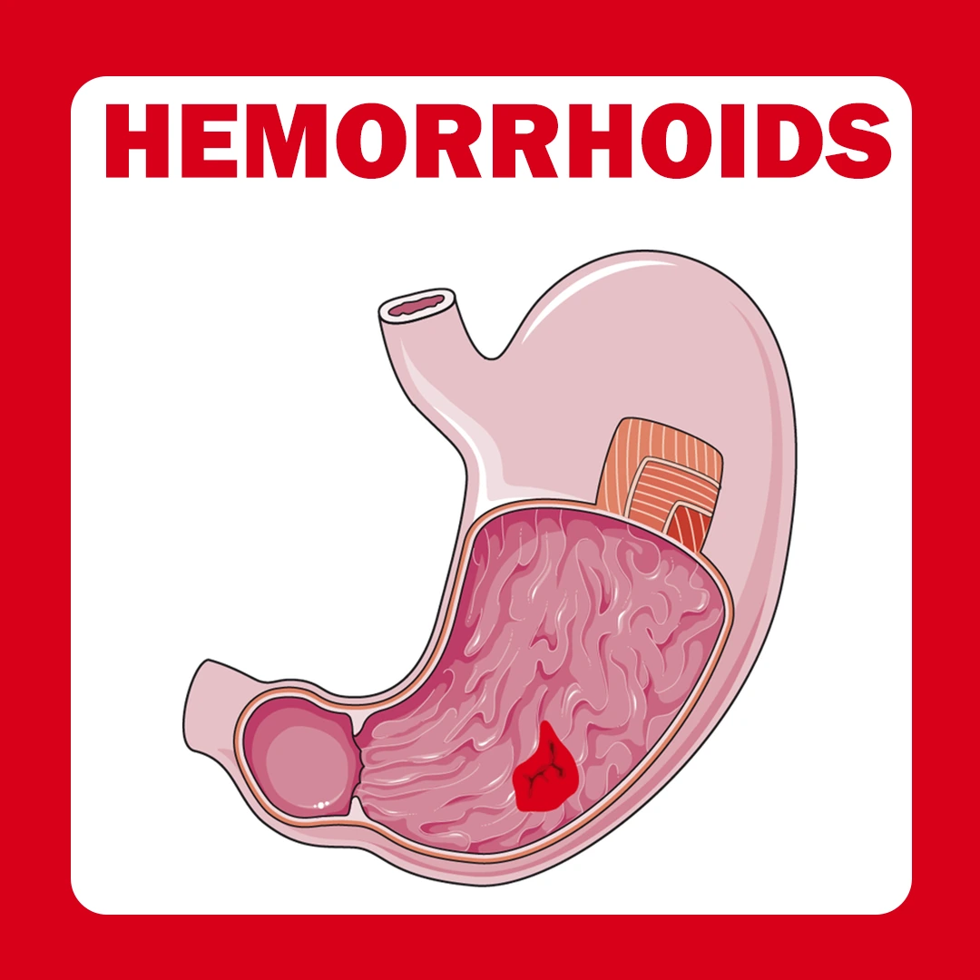 Hemorrhoids